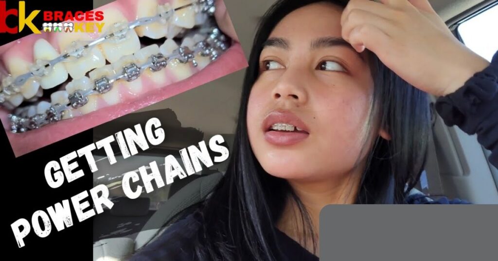 Get power chains when you first get braces