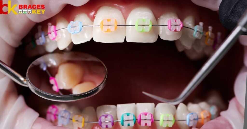How To Choose The Right Color Braces For You