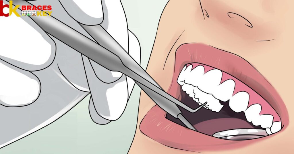 How To Clean Molar Bands