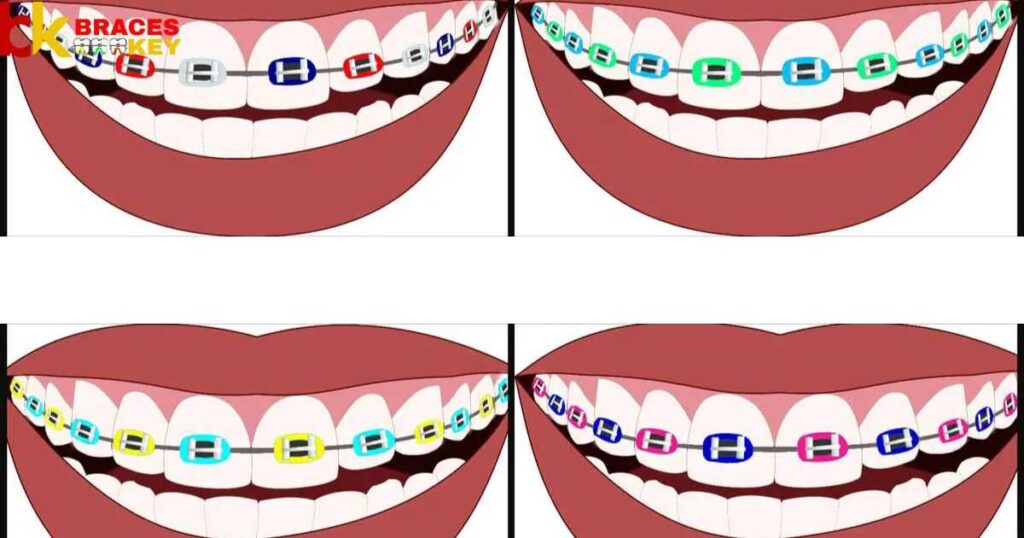 How To Pick The Best Braces Color For Your Teeth