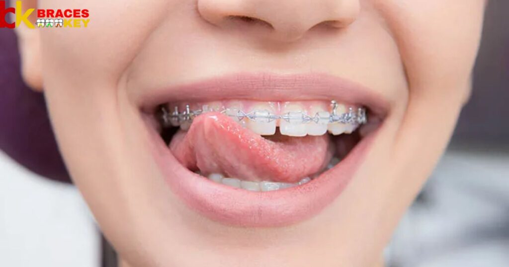 Is Dry Mouth With Braces A Common Problem