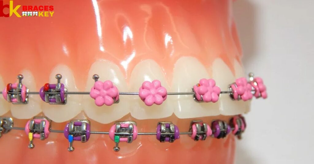 Is Pink A Good Color For Braces