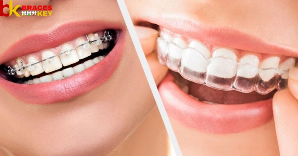 Know More About Different Braces And Their Costs