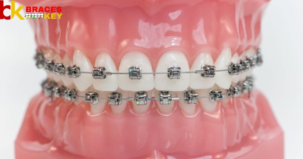Metal Ions From Orthodontic Appliances