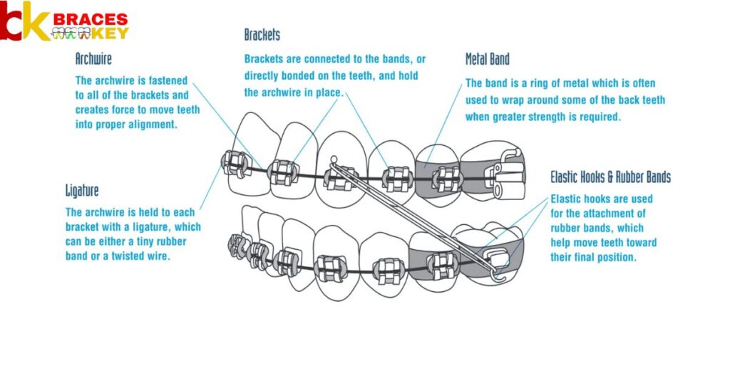 Orthodontic Wires And Their Uses