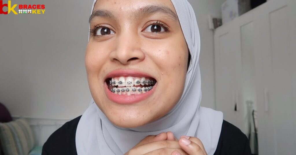 Overview Of Black A Good Color For Braces