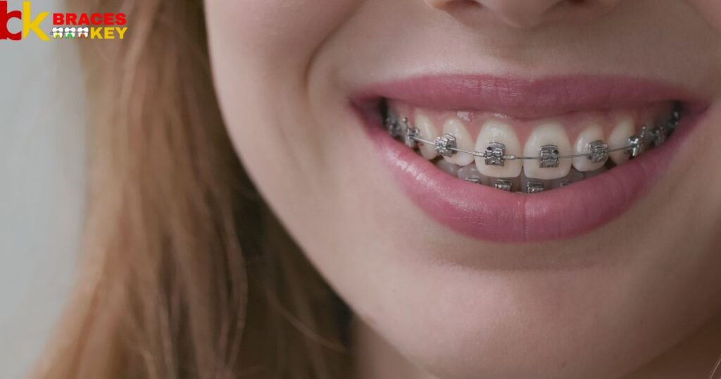 Overview Of Braces Cost Georgia