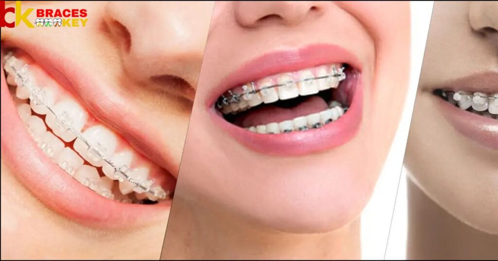 Overview Of Braces Cost In India
