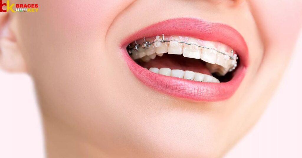 Overview Of Braces In Michigan