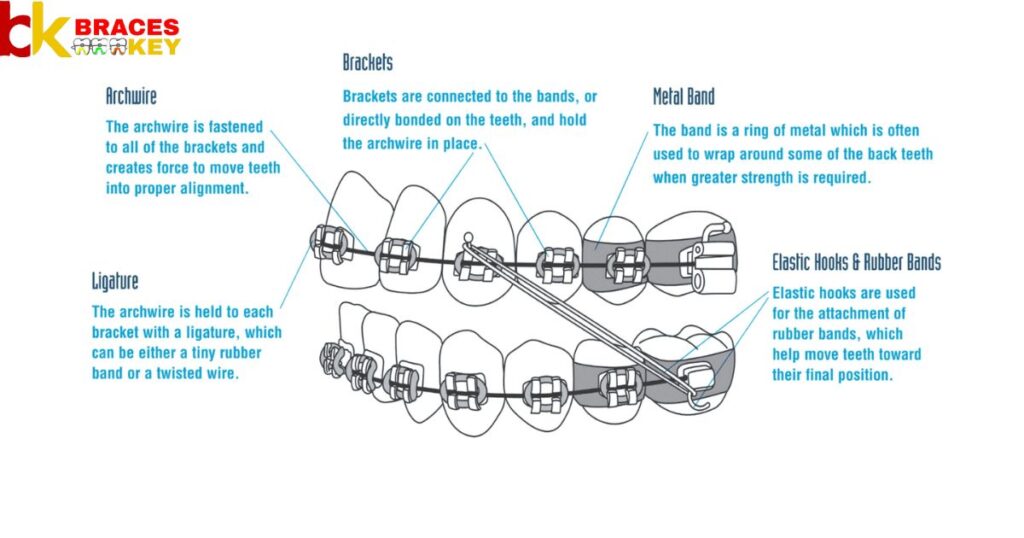 Overview Of Braces Wire Size Chart