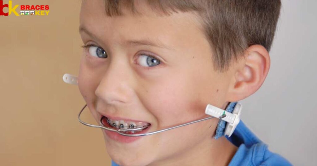 Overview Of Child Need Orthodontic Headgear