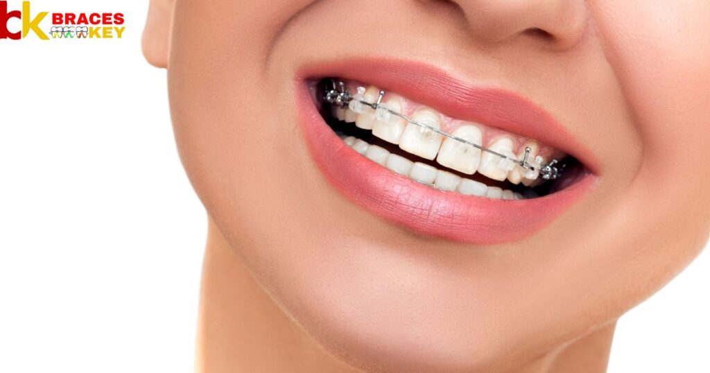 Overview Of Different Types Of Wires For Braces
