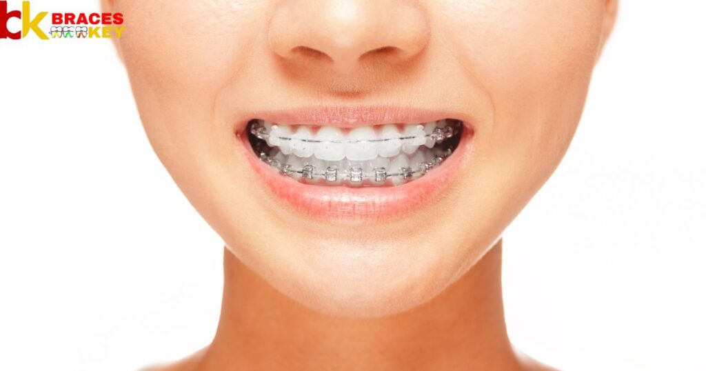Overview Of Dry Mouth With Braces