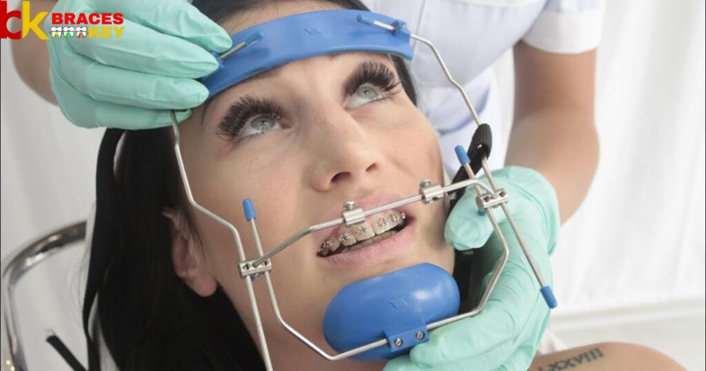 Overview Of Headgear And Braces