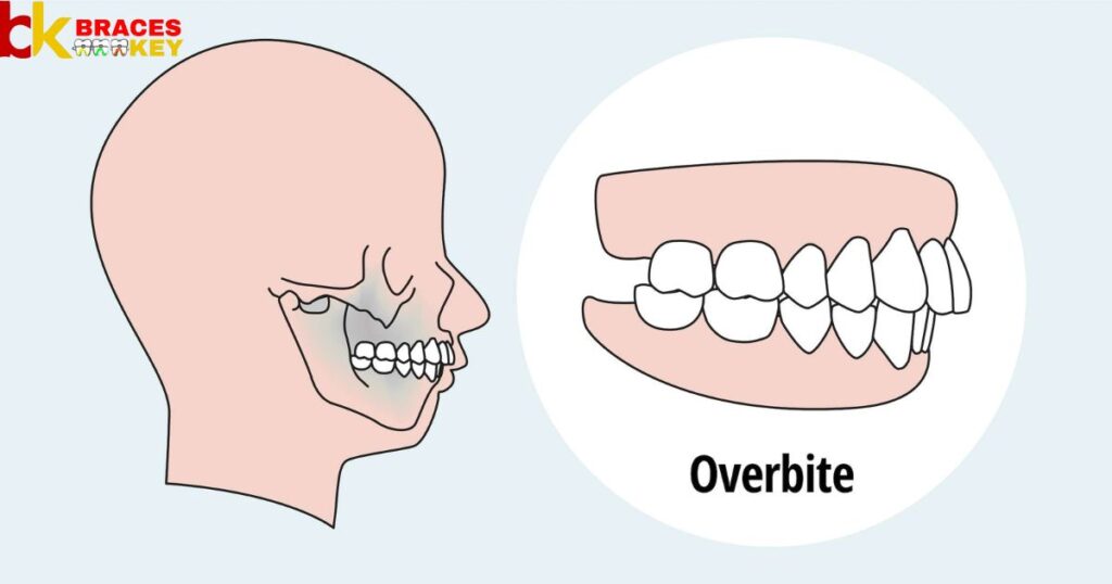 Overview Of Overbite