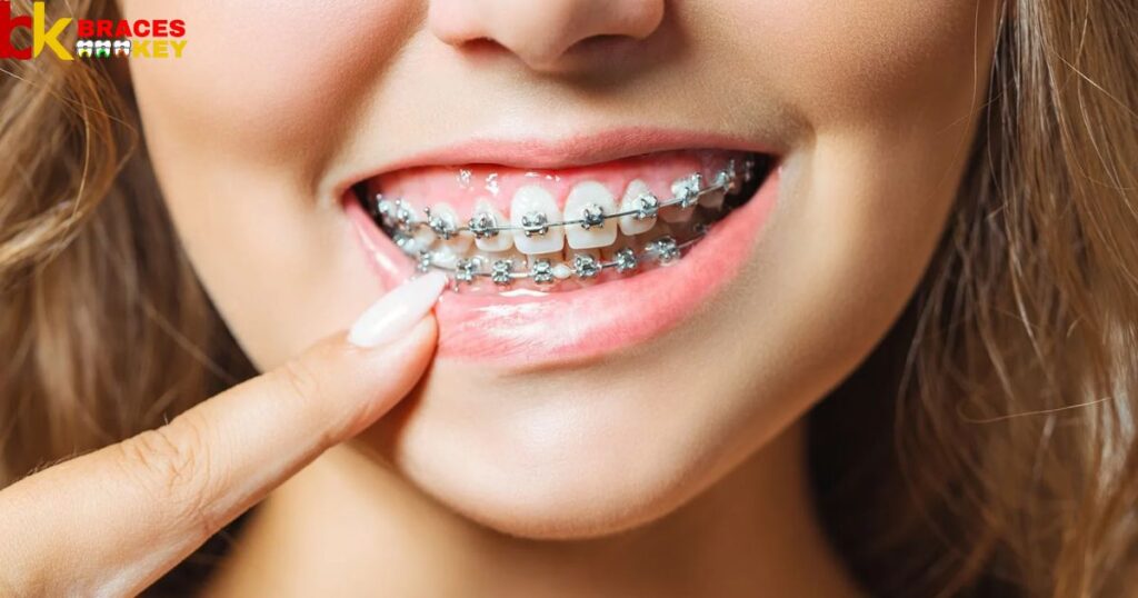 Overview Of Pain From Rubber Bands On Braces