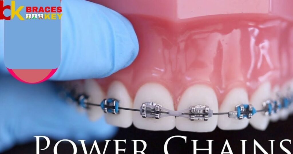 Overview Of Power Chains On Braces