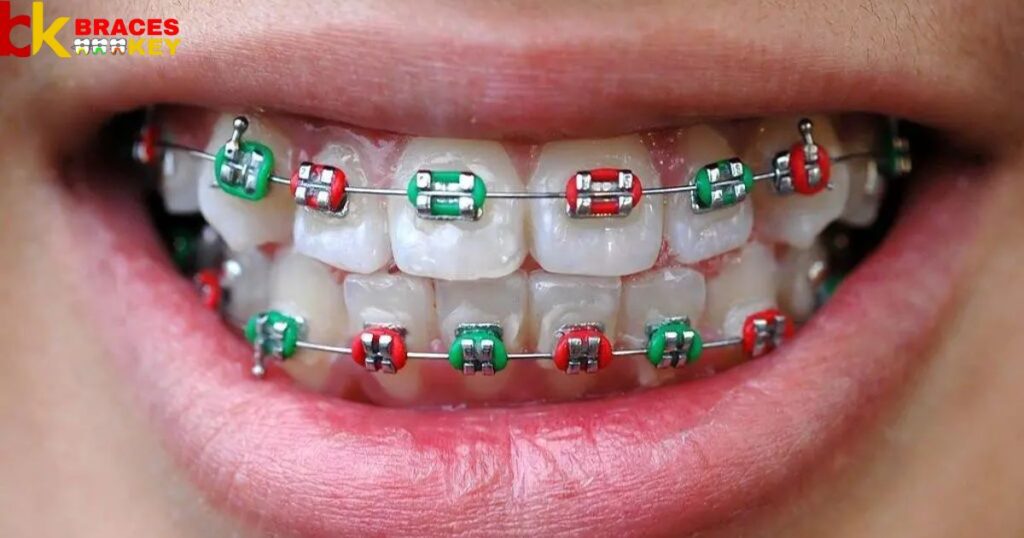 Overview Of Red A Good Color For Braces