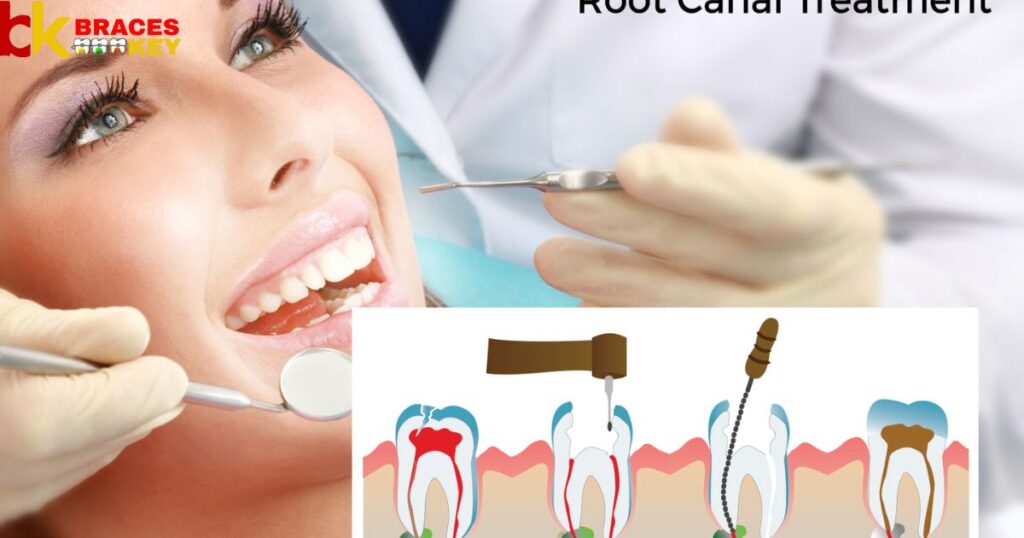 Overview Of Root Canal Treatment
