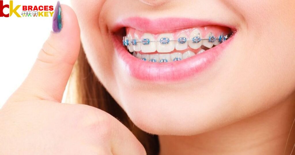 Overview Of Teal A Good Color For Braces