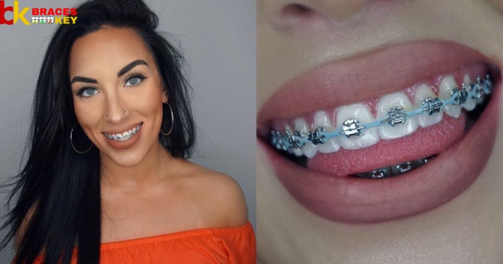 Power Chain Braces Before And After