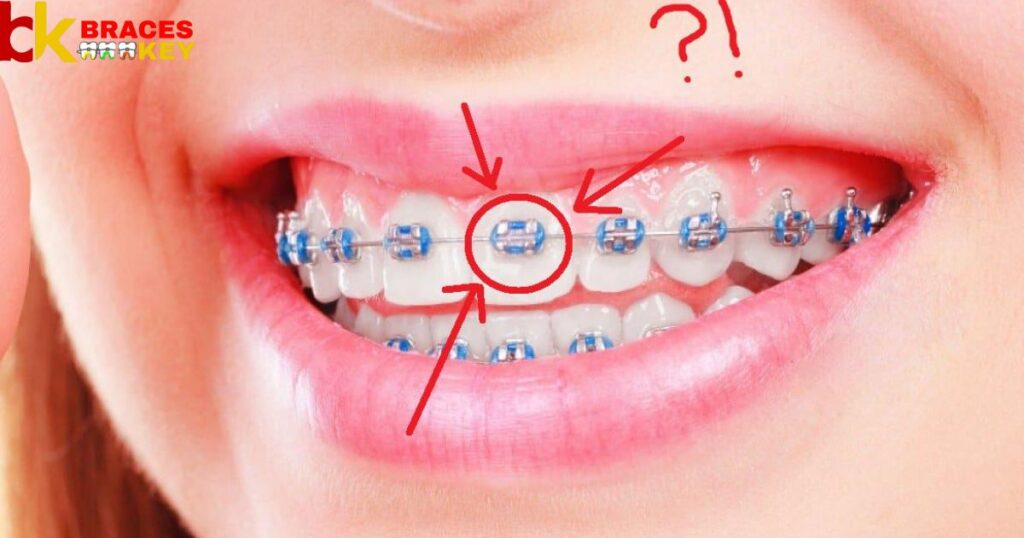 The Mexican Spanish Word For Braces