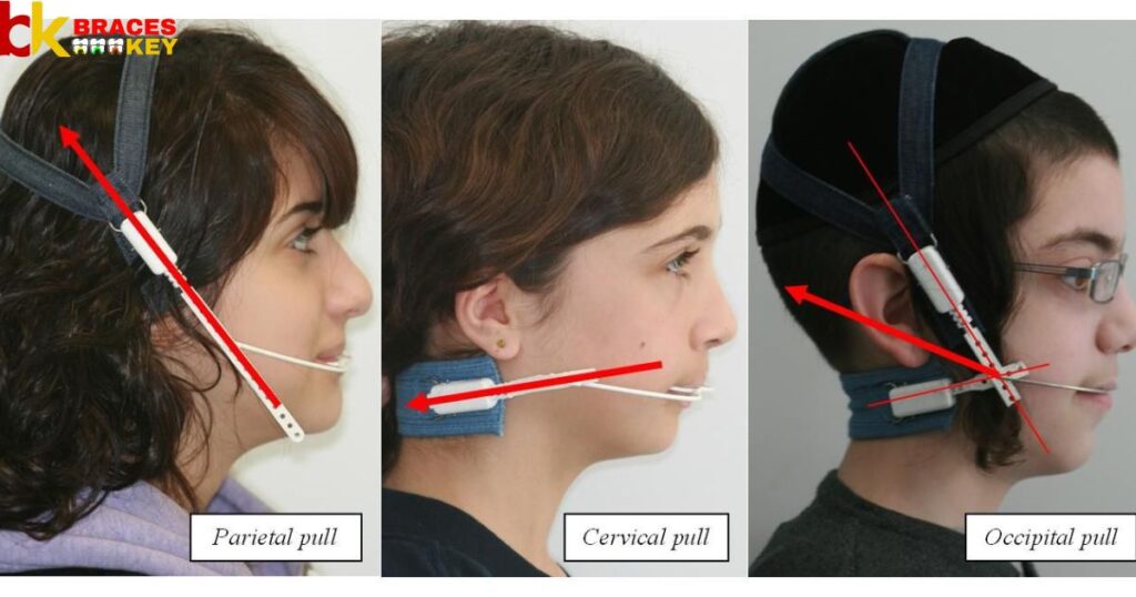 Three Main Types Of Headgear