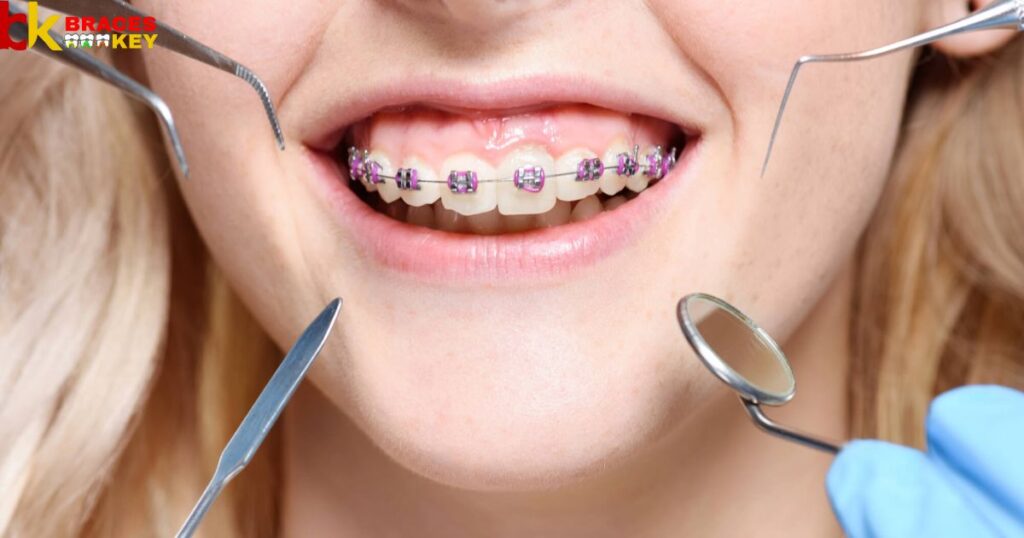 To Expect Power Chains In Your Orthodontic Treatment
