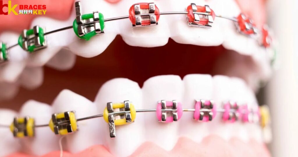 Top 5 Braces Colors To Choose For Whiter Looking Teeth