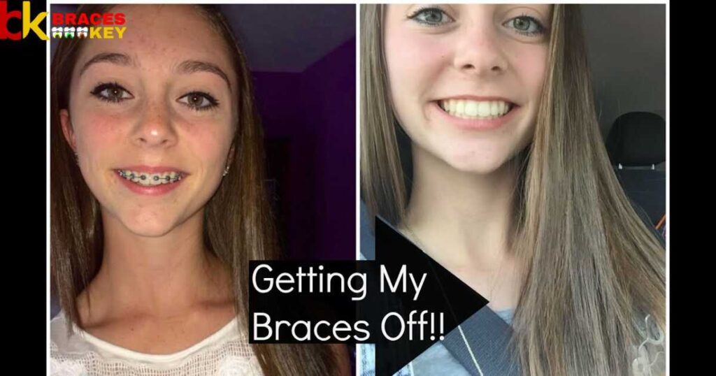 Tracing Their True Contours For Braces Off
