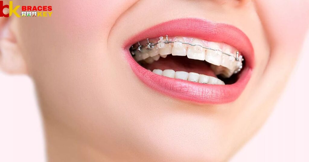 What Are The Benefits Of Braces