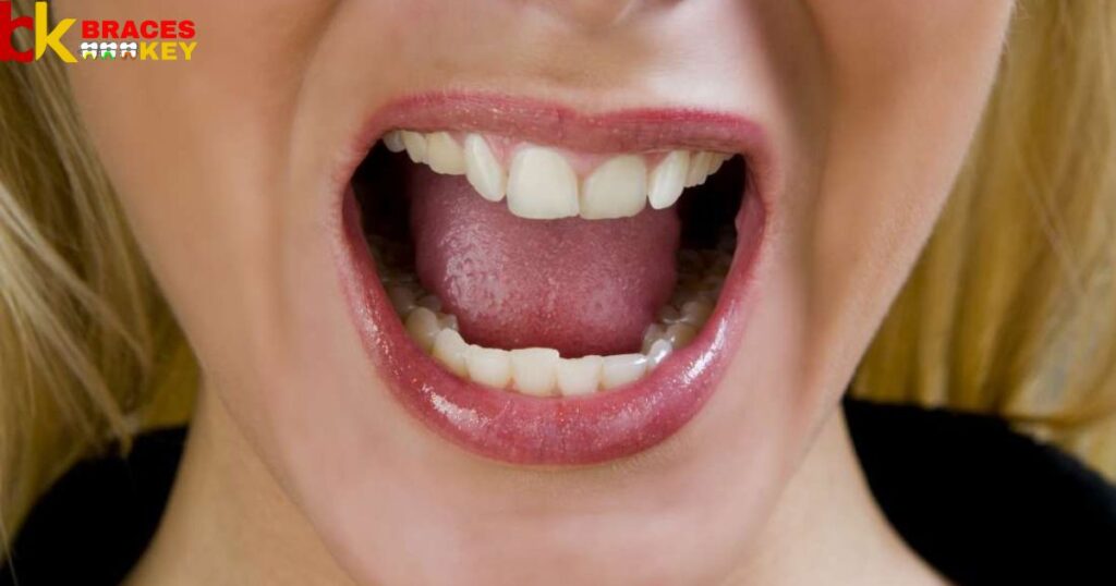 What Causes Dry Mouth Syndrome