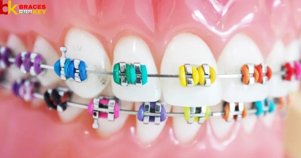 What Color Braces Make Your Teeth Whiter