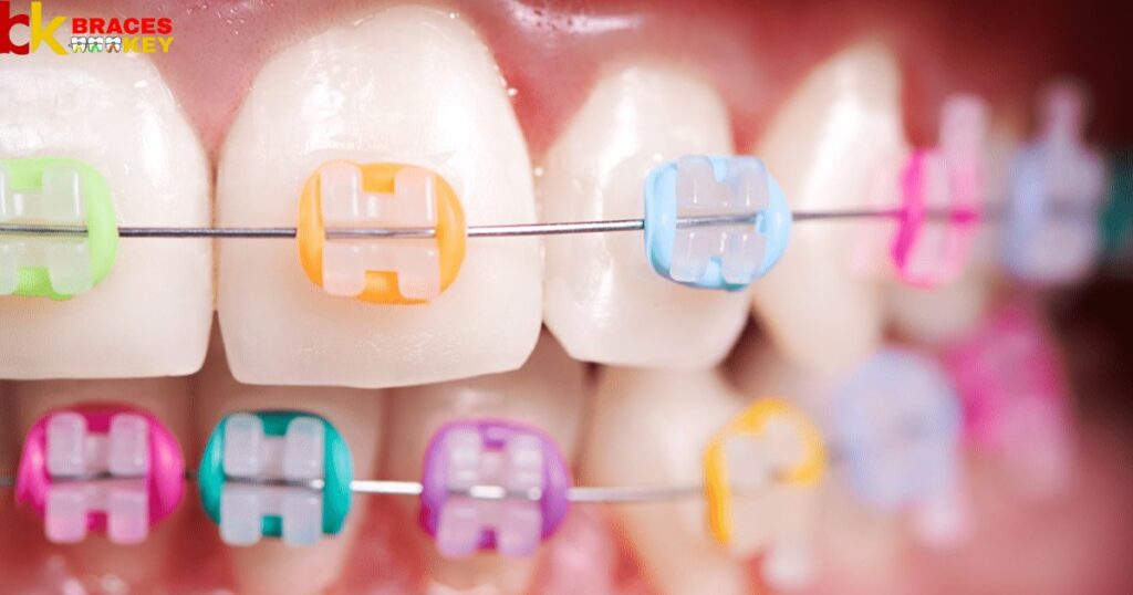 What Colors Of Braces Are Best And Which Should You Avoid