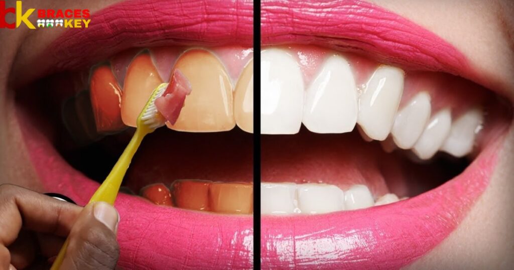What Is The Best Way To Whiten Your Teeth