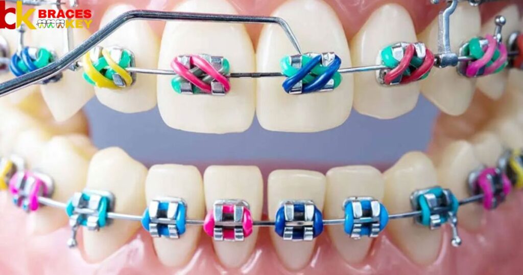 What Your Braces Color Says About You