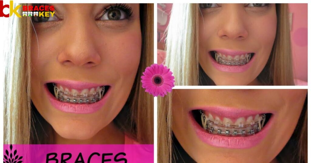 Why Are Pink Braces The Most Popular Color