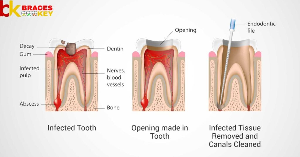 Why Root Canals Are Needed