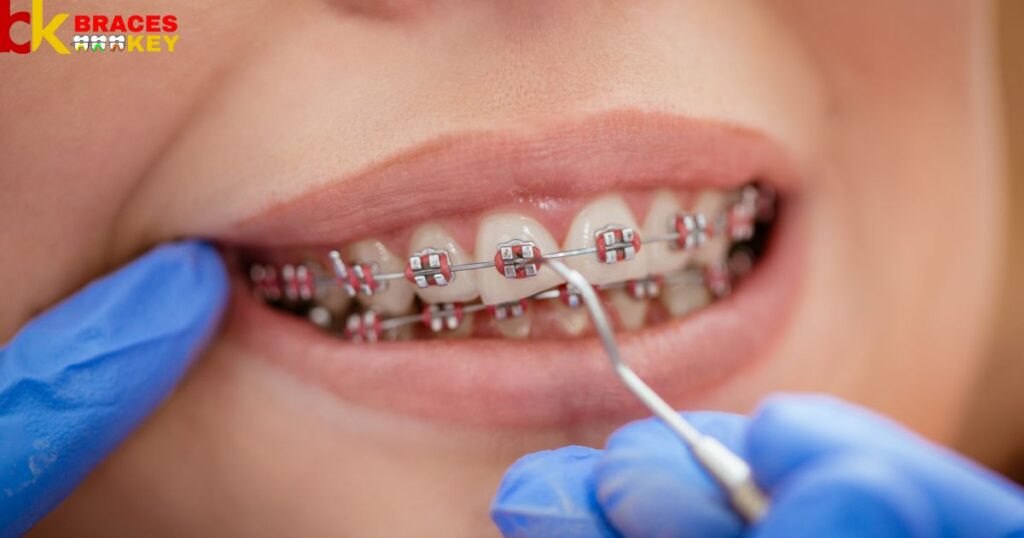 Average cost of braces without insurance