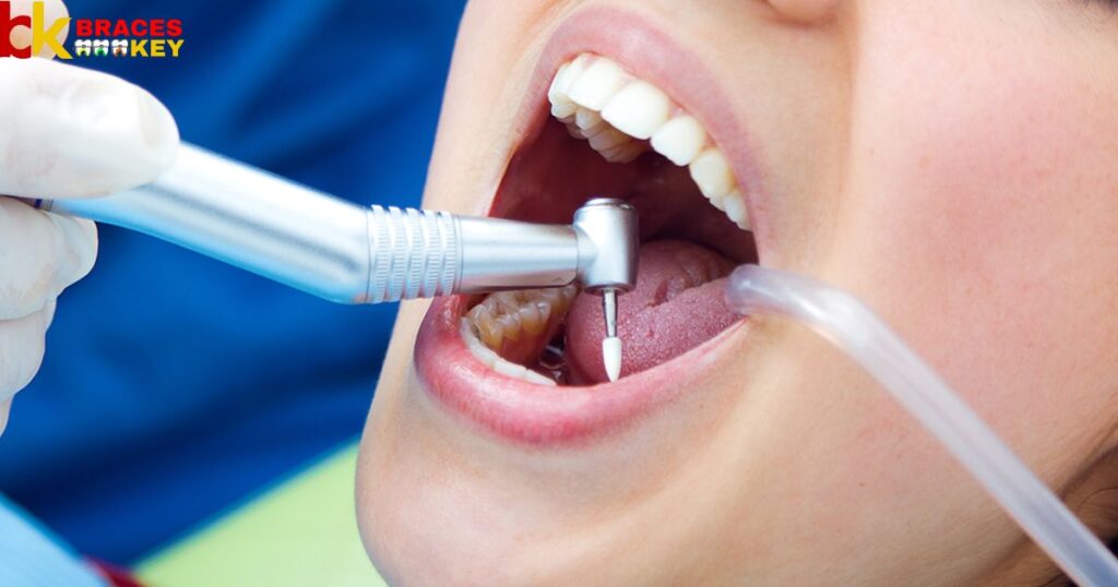 Cleaning And Filling The Root Canal
