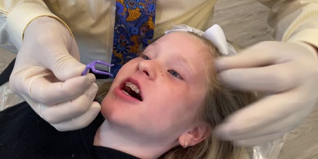 How to Floss With Braces Using a Harp Orthodontic Flosser