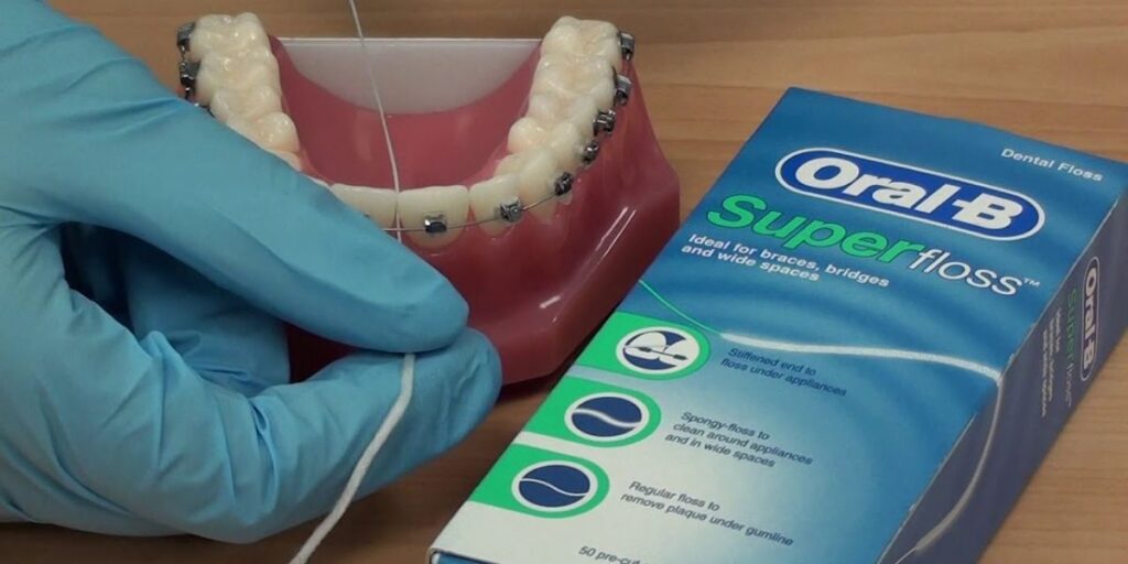 How to Floss With Braces Using Superfloss