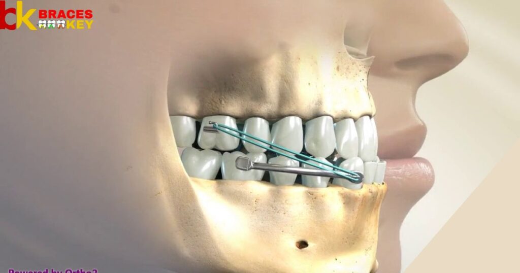Moving An Out-Of-Place Tooth With Coil Springs