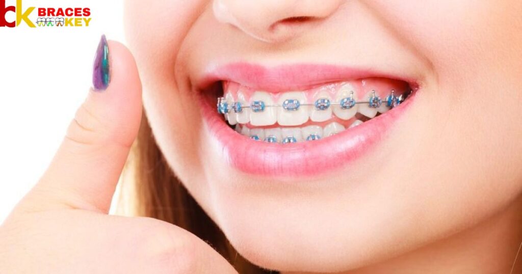 Overview Of Blue A Good Color For Braces