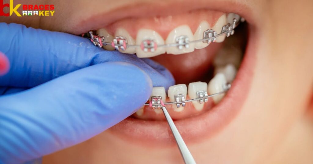 Overview Of Braces Cost