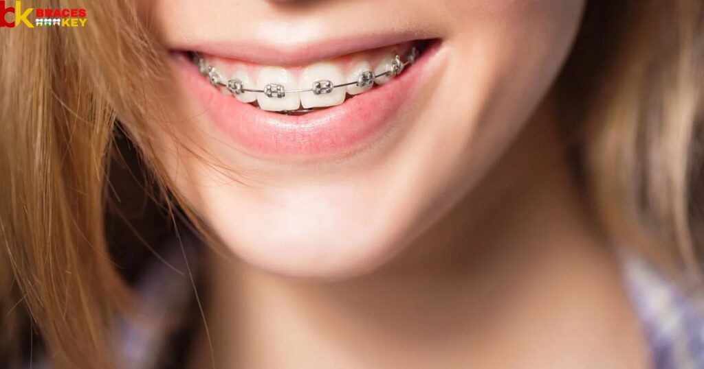 Overview Of Braces Take