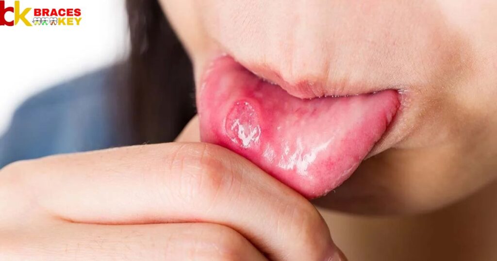 Overview Of Canker Sore