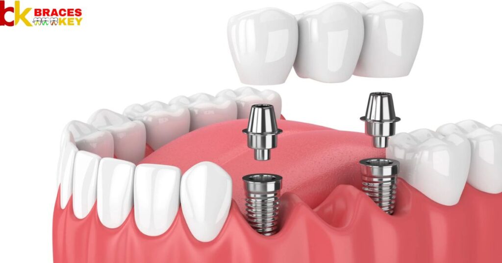 Overview Of Dental Implants