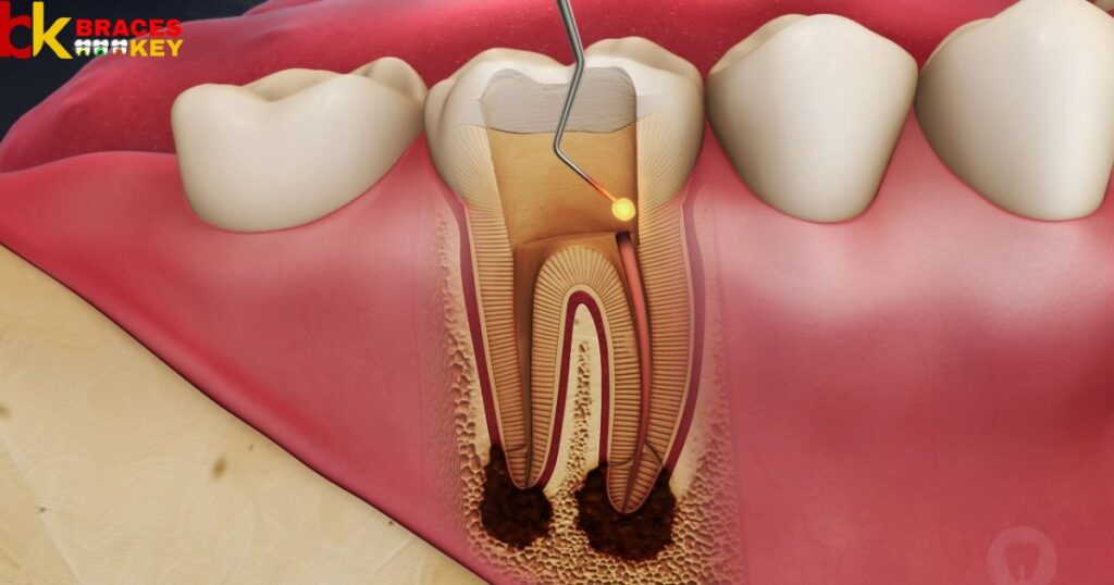 Overview Of Root Canal
