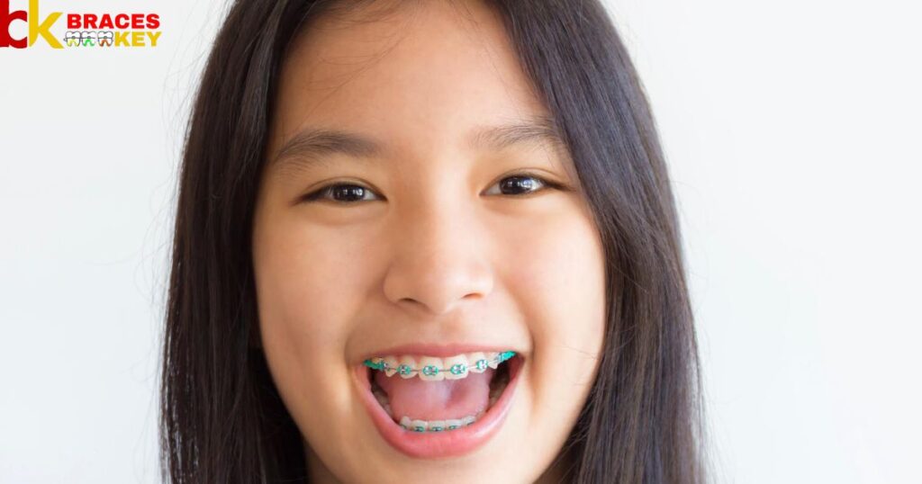 Overview Of The Best Braces Colors For Dark Skin